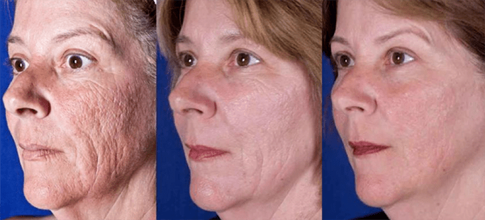 Rezultat po laserskem pomlajevanju kože obraza