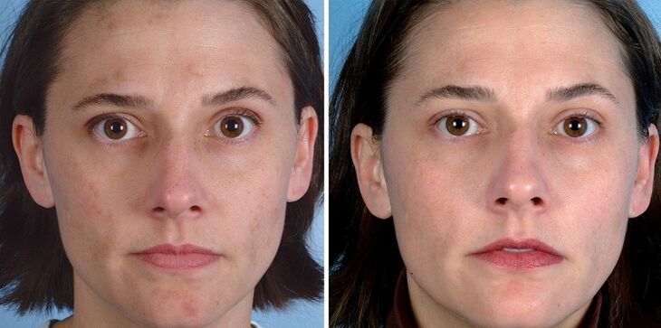pred in po pomlajevanju kože z napravo