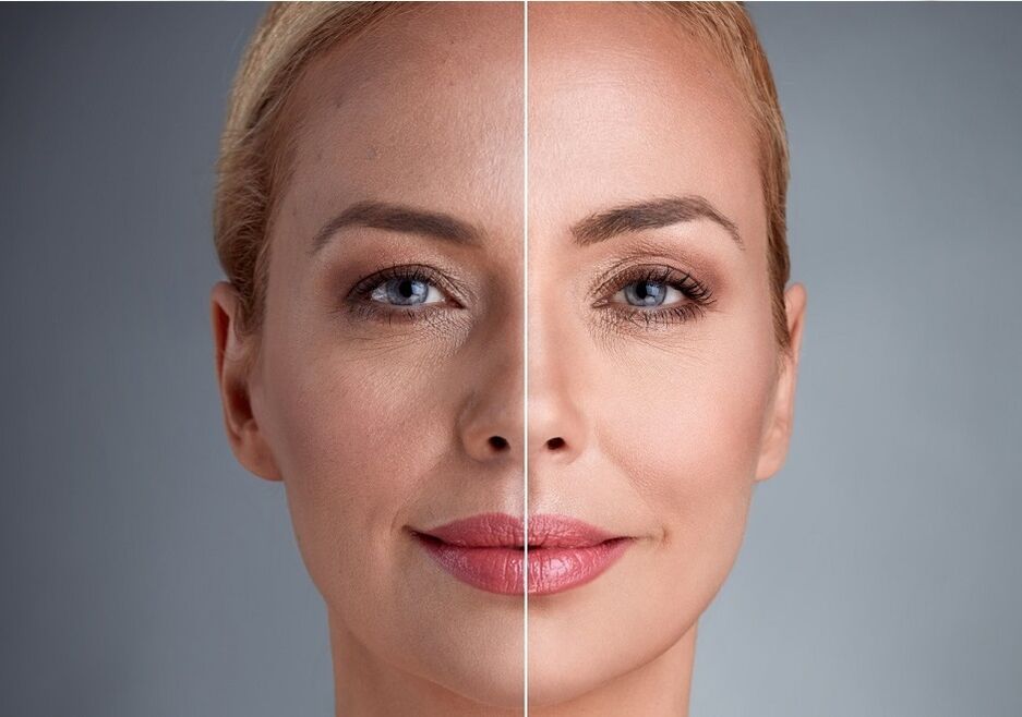 pred in po laserskem pomlajevanju obraza