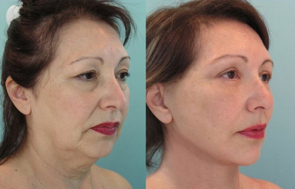 fotografija pred in po pomlajevanju kože