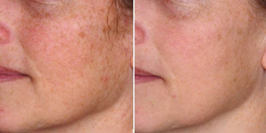 koža obraza pred in po pomlajevanju